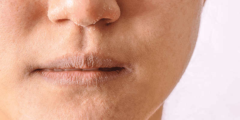 Dry Lips