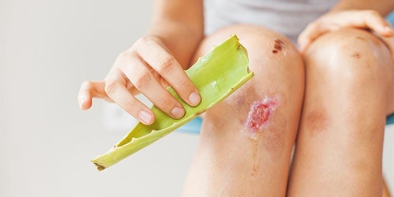 Aloe Vera for healing