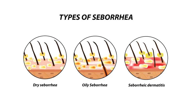 Types of Dandruff