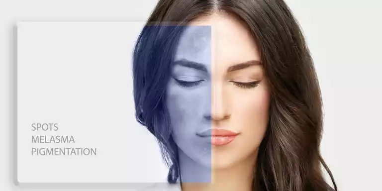 Skin Pigmentation