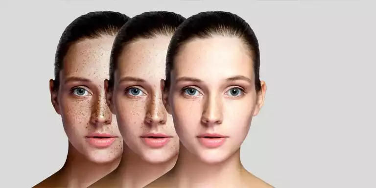 Overview of Pigmentation