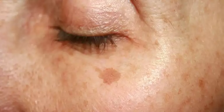 Prevent Skin Pigmentation