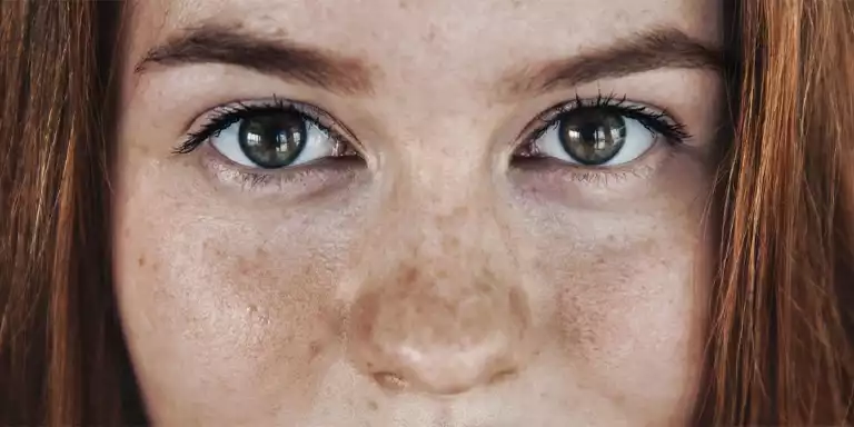 Home Remedies for Skin HyperPigmentation