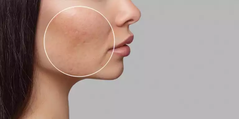 Cause of Skin Pigmentation