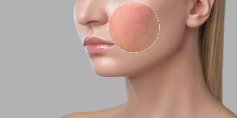 Treating Skin Pigmentation