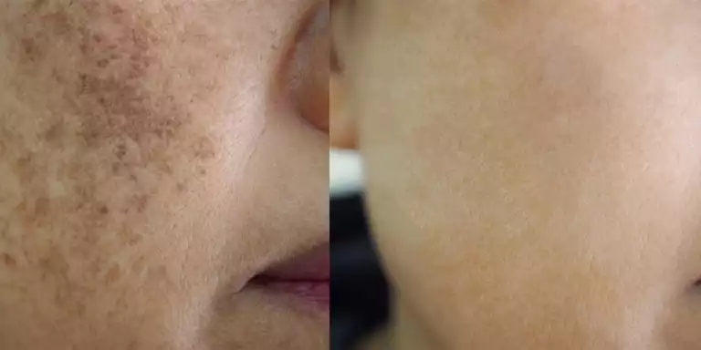 What is Skin Pigmentation