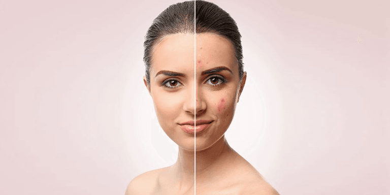 Avoid Using Comedogenic Products