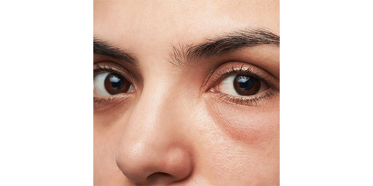 Eliminates Under Eye Bags & Dark Circles