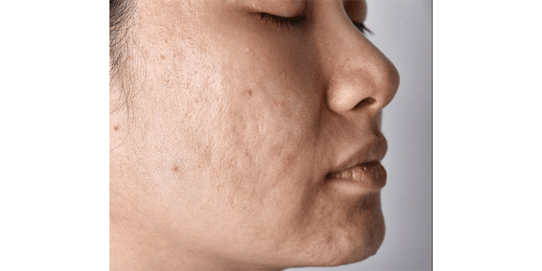 Improves Skin Texture