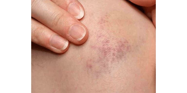 Promotes Wound Healing