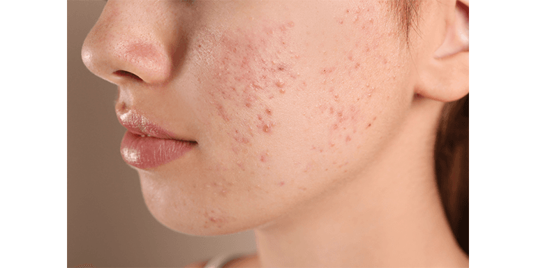 Soothes Irritated Skin