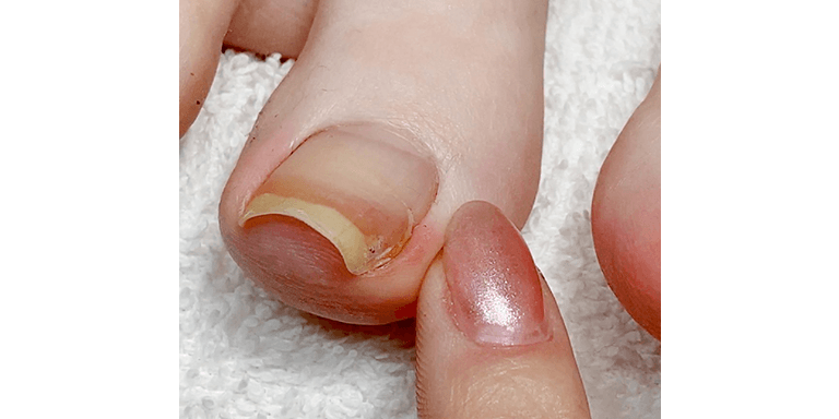 Ingrown Nails