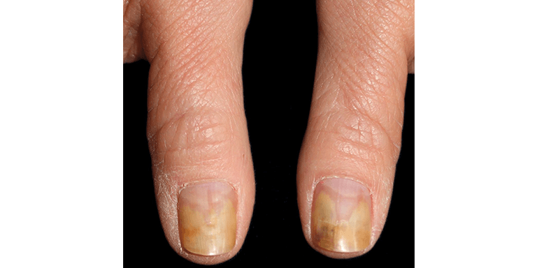 Nail Infections