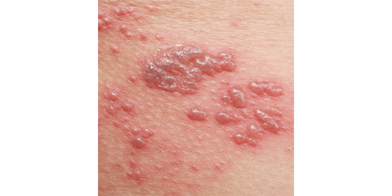 Blisters And Burns