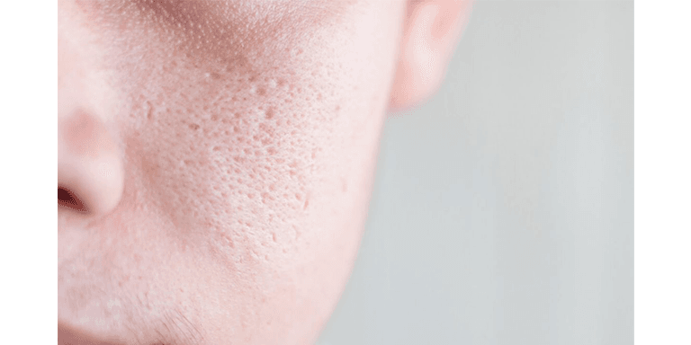 Decongests Our Skin’s Pores