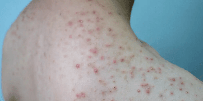 Folliculitis for laser hair removal treatment
