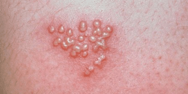 Herpes Simplex