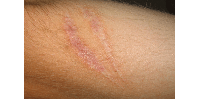 Scarring