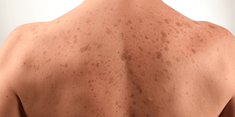 Skin Color Changes