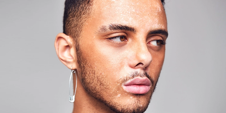 reduces hyperpigmentation