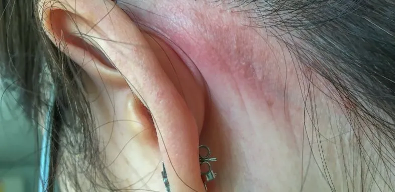 Allergic Reactions