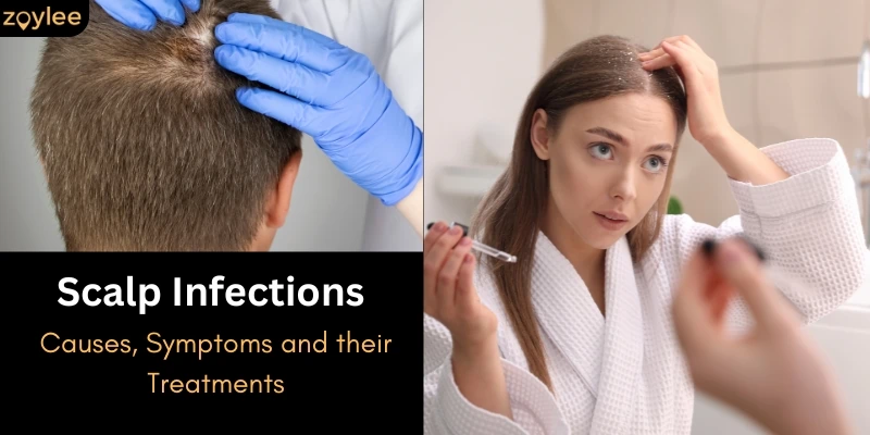 Scalp Infections: Causes, Symptoms and their Treatments